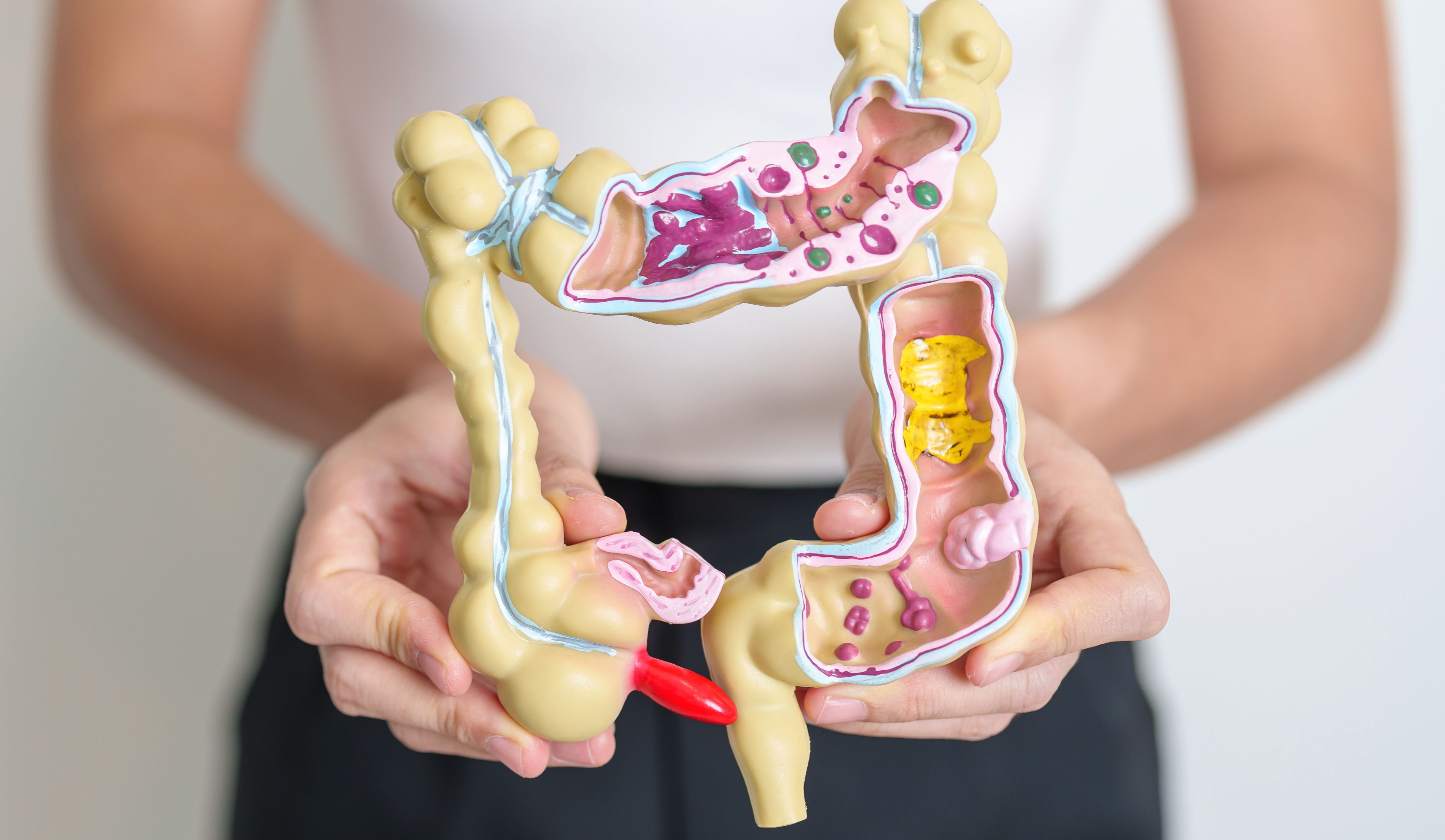 Reizdarm behandeln: Ursachen, Symptome & was hilft